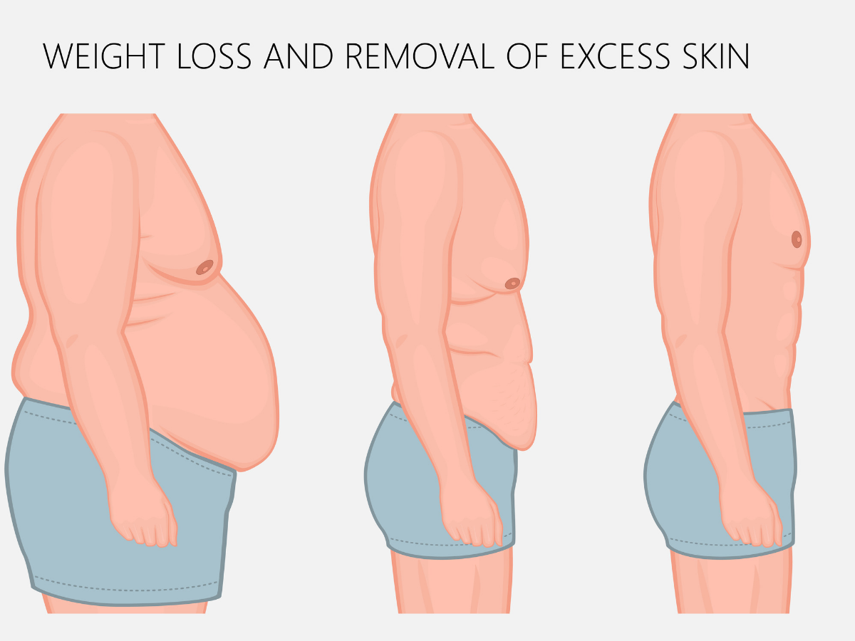 How to Prevent Loose Skin During Weight Loss: Expert Tips & Tricks