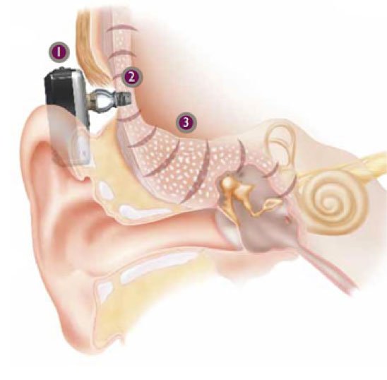 bone anchored hearing aid