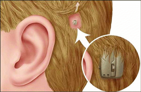 bone-anchored hearing aids