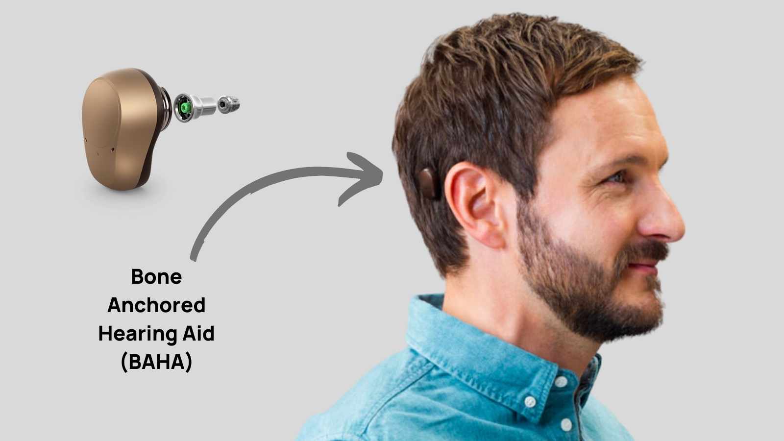 bone-anchored hearing aids