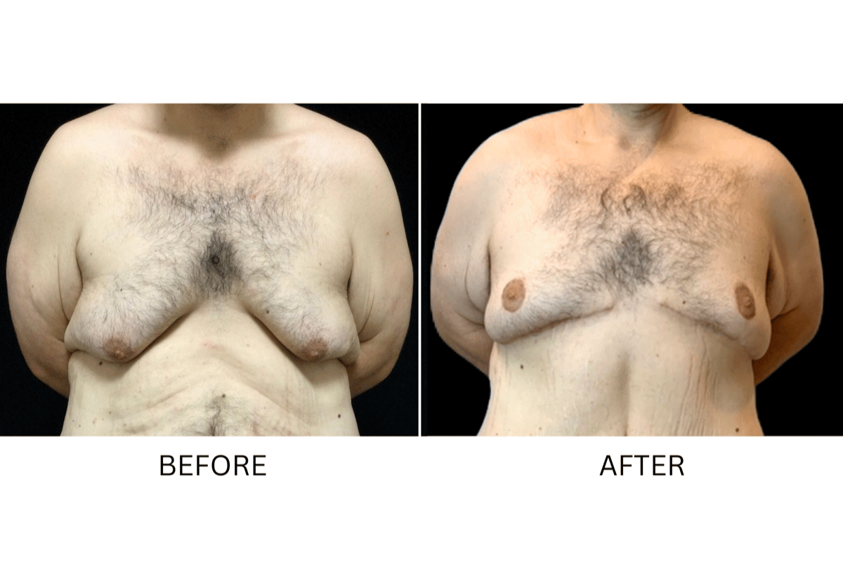 losing breast during weight loss