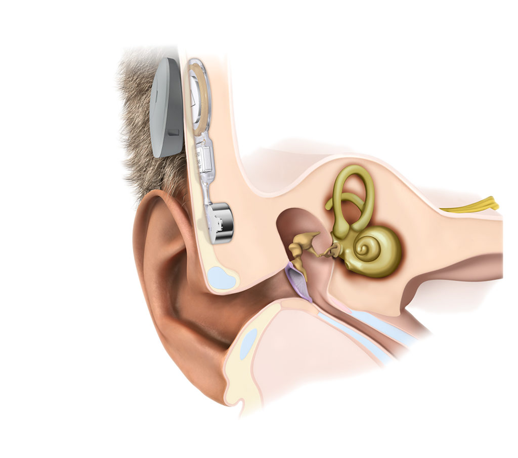 bone conduction hearing aids