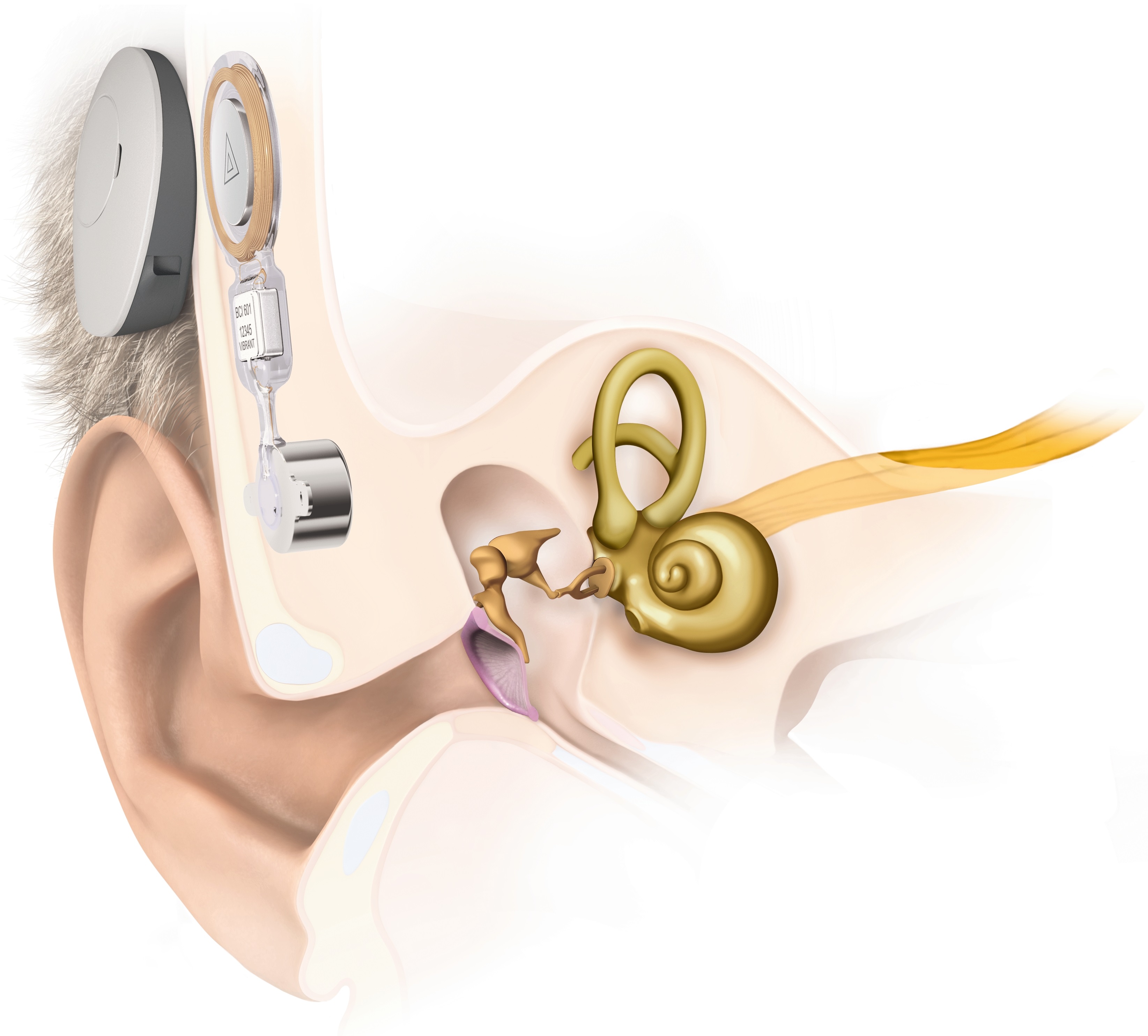 bone conduction hearing aid