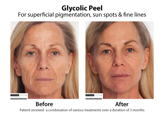 https://img.siterank.app/topic/90-days-with-glyco-pezil-real-skin-before-after-stories-tiny-wins-and-honest-regrets-697779f3324ea.png