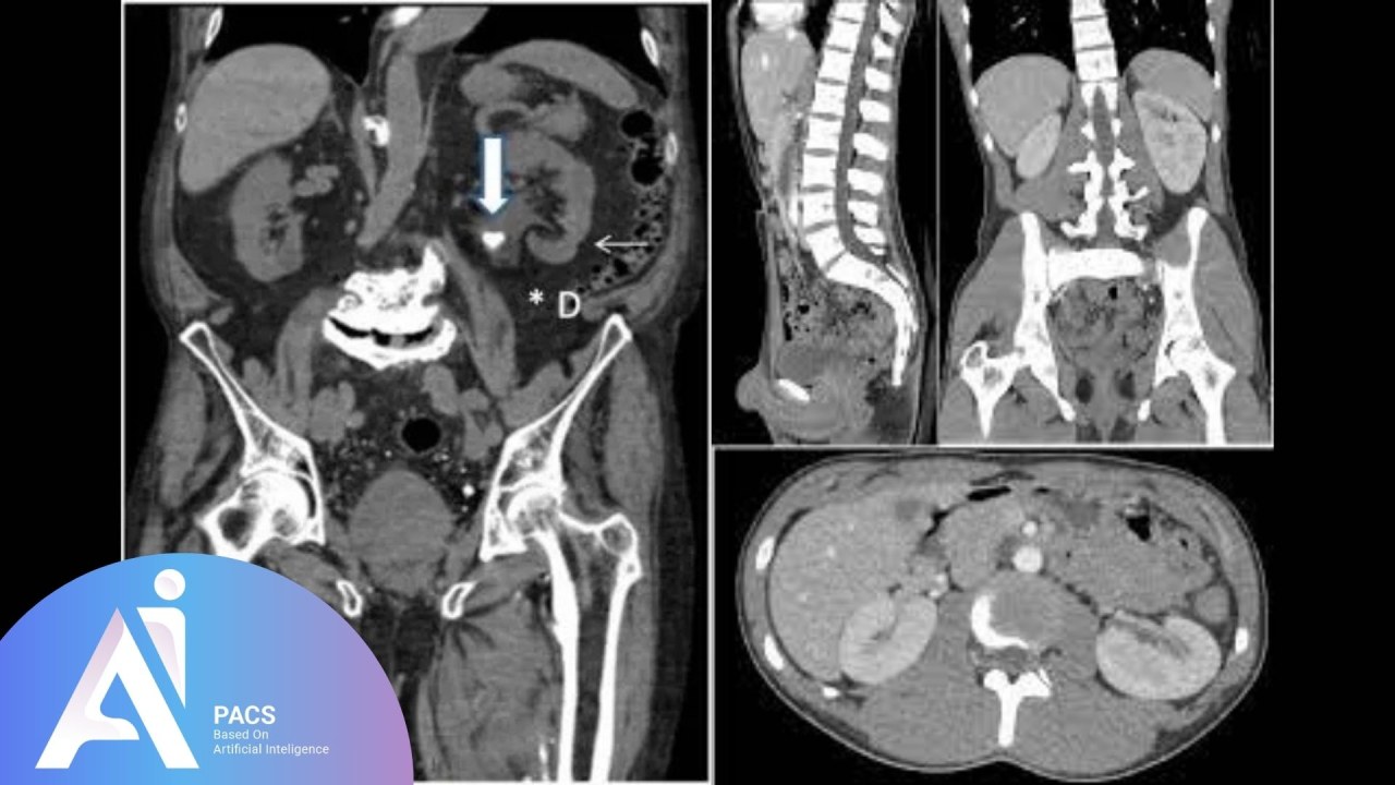 semaglutide and visceral fat Does Ozempic Help Visceral Fat? My Patients' 6‑Month Scan Results (2026  Update)