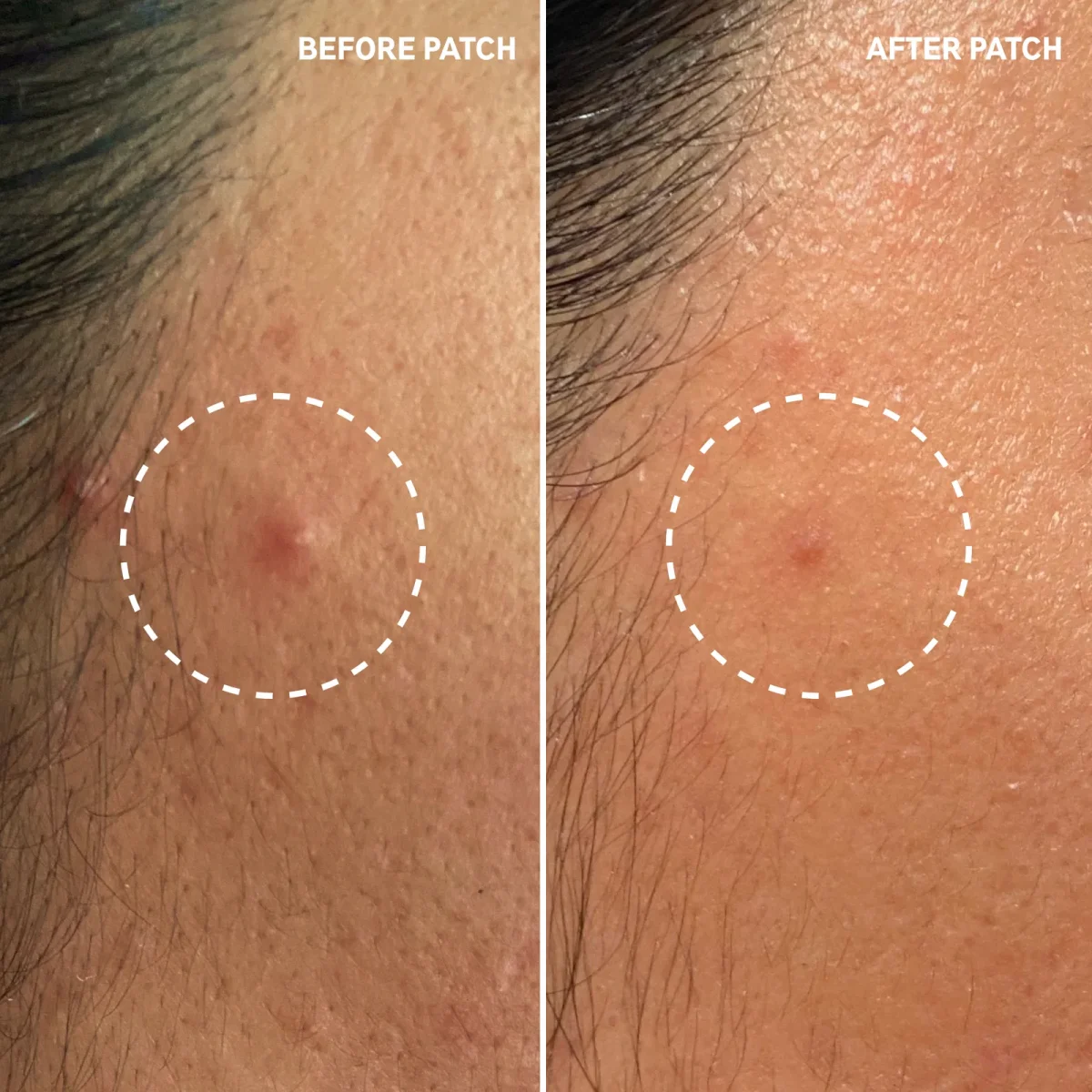 why did kind patches change from glp 1 to berberine 5 Things I Learned From 12 Weeks of Purisaki Weight Loss Patches: Real  Before and After Reviews