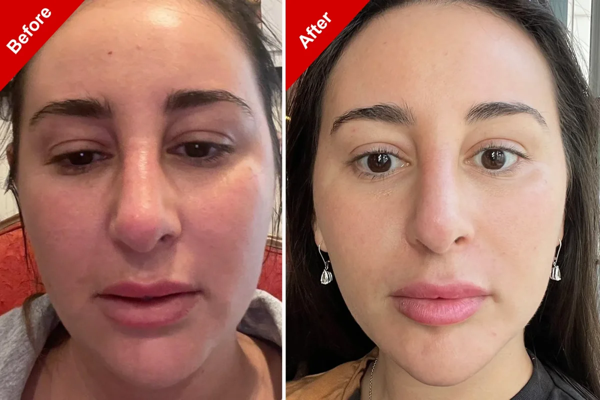 What Do Peptide Weight Loss Results Really Feel Like in 612 Weeks (2026)?  A Calm, Real-World Look Beyond BeforeandAfter Hype